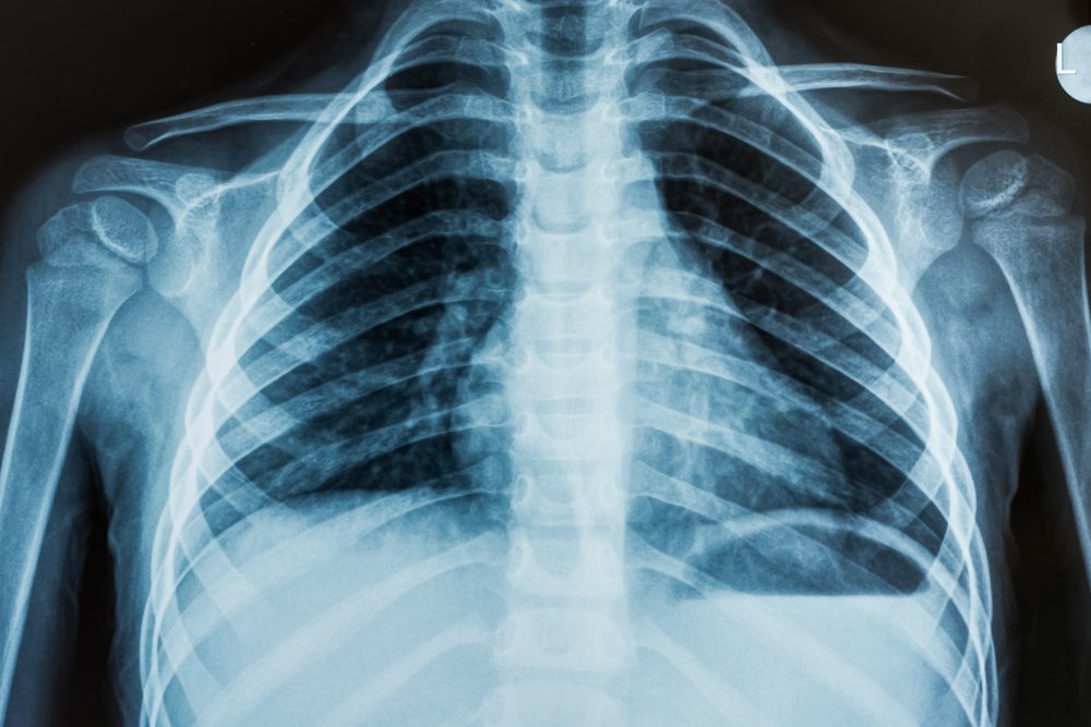 Цифровая рентгенография: показания, преимущества - «Фото»