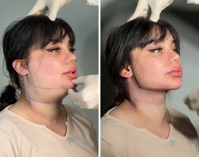 15 преображений из пластической клиники, которые взорвали интернет благодаря одному приёму - «Смешное»